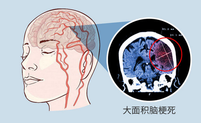 脑梗死患者越来越多，3种调料是元凶