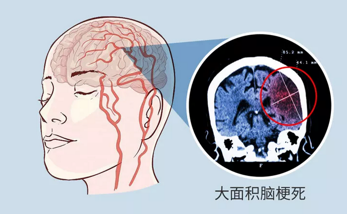 脑梗死越来越多，3种调料是元凶