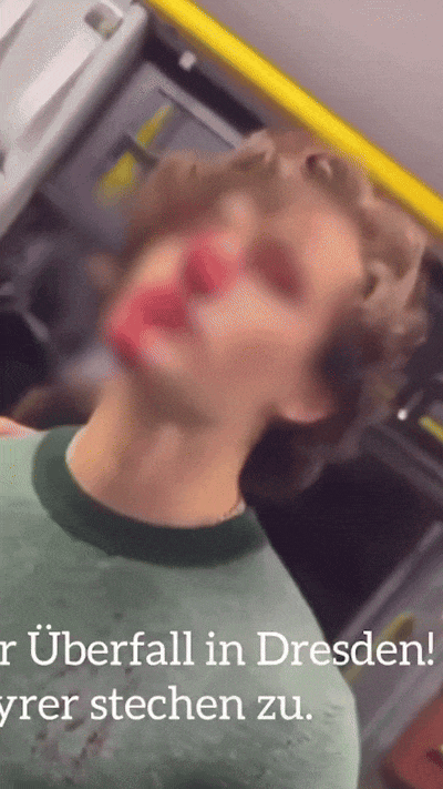 男模救人遭毁容，嫌犯却被释放