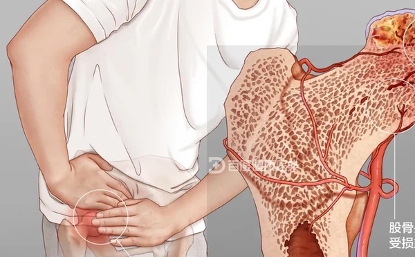 股骨头坏死到底是一种什么病？
